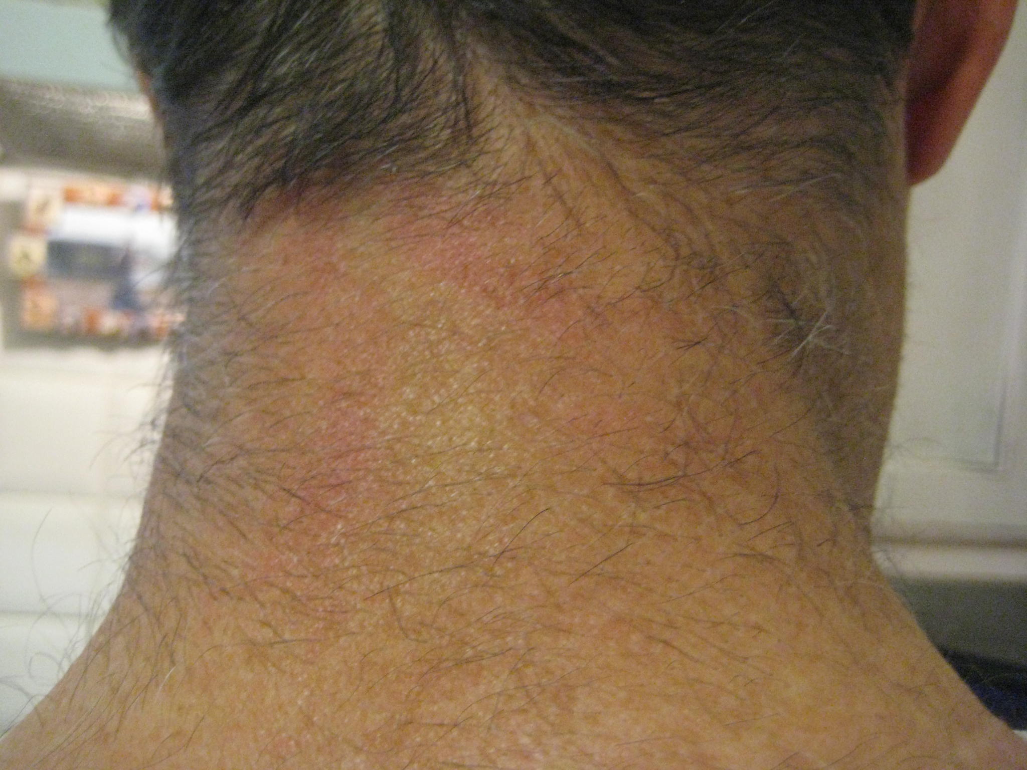 swollen lymph node on back of head
